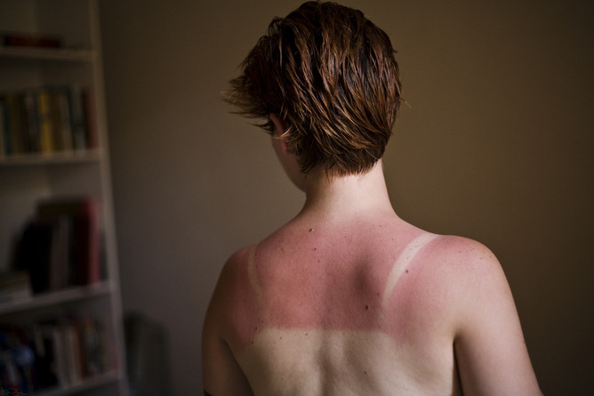 Bad sunburn increases your risk of melanoma.
