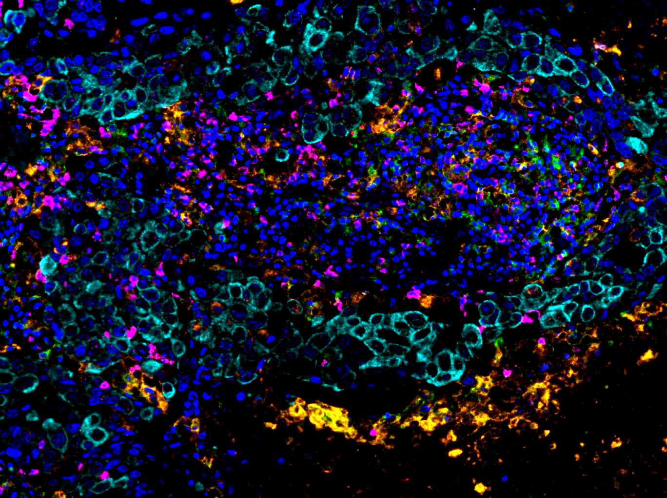 The Complex Microenvironment of Human Breast Cancer