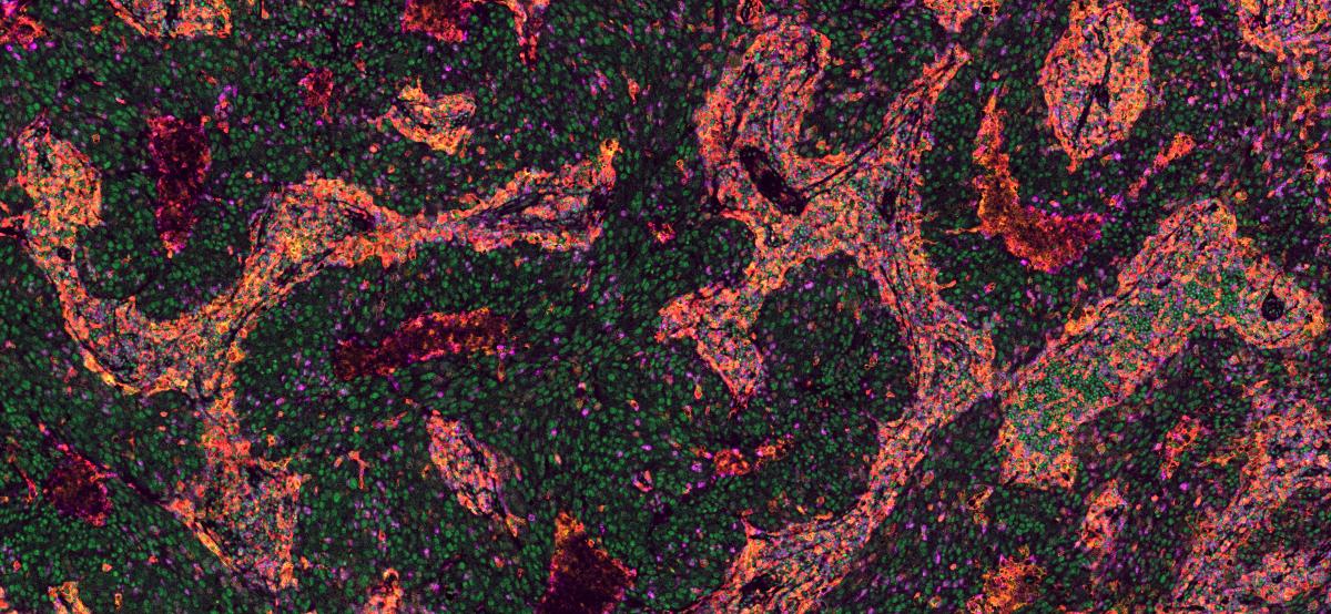 Melanoma immune heterogeneity