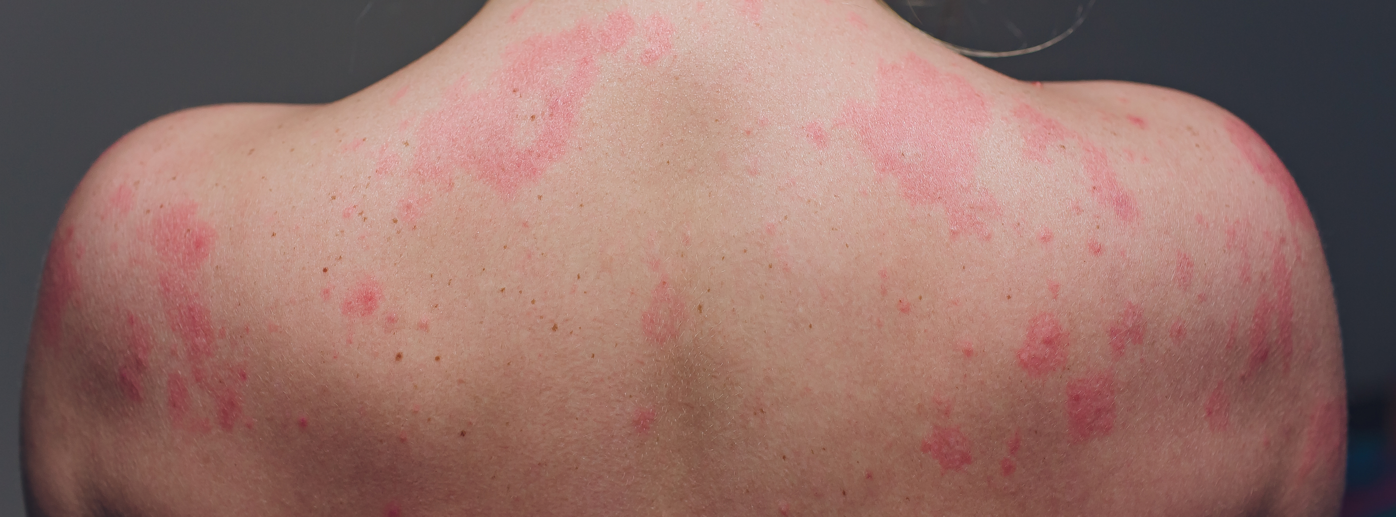 Common Skin Rashes And What To Do About Them Faculty Of Medicine 