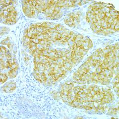 Areas containing RAB27A molecules (brown staining) within a section of a melanoma.