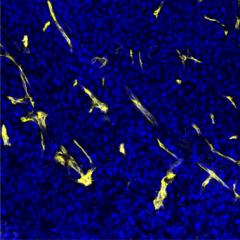 Blood vessels (yellow) within a melanoma tumour.