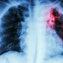 Colour enhanced x-ray showing tuberculosis lesion 