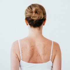 Moles on back