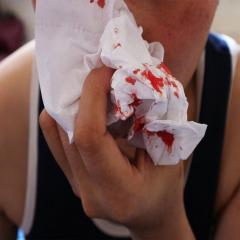 Child with nosebleed holding tissue to nose.