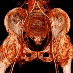 Scan - both hip joints affected by NHO 