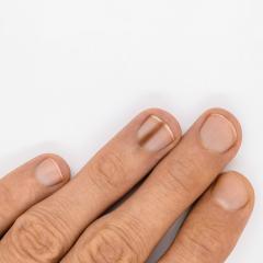 Nail matrix melanoma