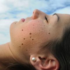 Image of woman with naevus