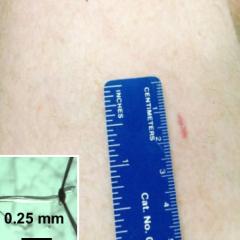Thigh biopsy