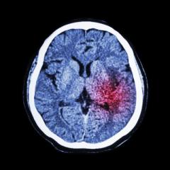 Electrical therapy offers promise for stroke patients