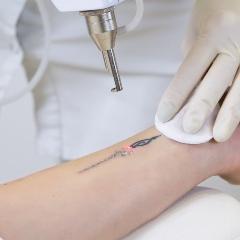 Laser pointed at tattooed hand 