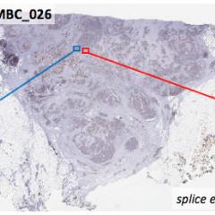 A scan of a single MBC tumour, with different regions containing diverse cell types